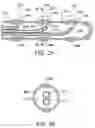 Fig. 09 - Extended treatment zone catheter