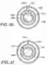 Fig. 12 - Extended treatment zone catheter