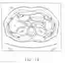 Fig. 18 - Method for determining the risk of rupture of a blood vessel