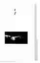 Fig. 31 - Method for determining the risk of rupture of a blood vessel