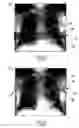 Fig. 03 - Method and apparatus for using tomography for placement of an instrument