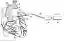 Fig. 01 - Cardiac ablation using microbubbles