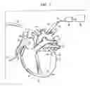 Fig. 02 - Cardiac ablation using microbubbles