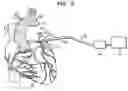 Fig. 03 - Cardiac ablation using microbubbles