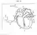 Fig. 04 - Cardiac ablation using microbubbles