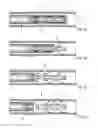 Fig. 03 - Instrumented retrievable implantable device