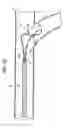 Fig. 12 - Steerable loop tip wire-guide