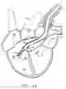 Fig. 15 - Transport pump and organ stabilization apparatus including related methods