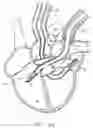 Fig. 17 - Transport pump and organ stabilization apparatus including related methods
