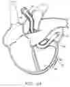 Fig. 24 - Transport pump and organ stabilization apparatus including related methods