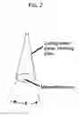 Fig. 06 - METHODS AND DEVICES FOR SELECTIVE BULK REMOVAL AND PRECISION SCULPTING OF TISSUE