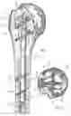 Fig. 02 - System for fixation of bone fractures