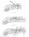 Fig. 07 - Intramedullary fixation device for metaphyseal long bone fractures