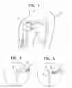 Fig. 02 - Method and apparatus for repair of torn rotator cuff tendons
