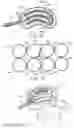 Fig. 06 - Inflatable device for use in surgical protocol relating to fixation of bone