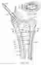 Fig. 08 - Inflatable device for use in surgical protocol relating to fixation of bone
