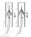 Fig. 06 - Blood clot filter configured for a wire guide
