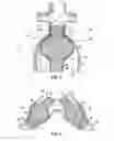Fig. 03 - Endoluminal device having enhanced affixation characteristics
