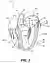 Fig. 06 - Devices and methods for heart valve treatment