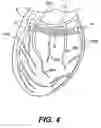 Fig. 07 - Devices and methods for heart valve treatment