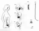 Fig. 02 - Bladder implant