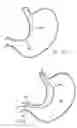 Fig. 49 - Remote tissue retraction device