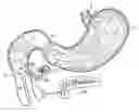 Fig. 01 - Pancreatic exocrine secretion diversion apparatus and method