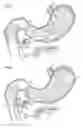 Fig. 02 - Pancreatic exocrine secretion diversion apparatus and method
