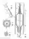 Fig. 03 - Balloon catheter having a balloon with a thickened wall portion