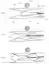 Fig. 02 - Endoluminal delivery of anesthesia