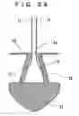 Fig. 24 - Lacrimal punctum plug