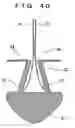 Fig. 25 - Lacrimal punctum plug