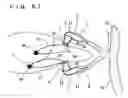 Fig. 46 - Lacrimal punctum plug