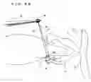 Fig. 47 - Lacrimal punctum plug