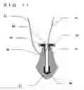 Fig. 50 - Lacrimal punctum plug