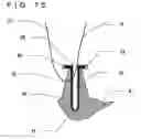 Fig. 52 - Lacrimal punctum plug