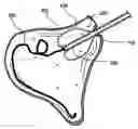 Application 20060106361, fig. 01