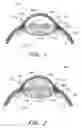 Fig. 02 - Minimally invasive glaucoma surgical instrument and method