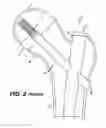 Fig. 03 - Intramedullary nail assembly