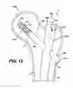 Fig. 14 - Intramedullary nail assembly