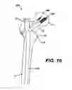 Fig. 19 - Intramedullary nail assembly