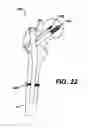 Fig. 23 - Intramedullary nail assembly
