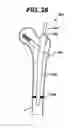 Fig. 27 - Intramedullary nail assembly