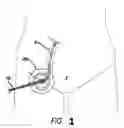 Fig. 02 - Endovascular surgical method