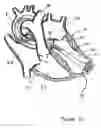 Fig. 06 - Catheter-based tissue remodeling devices and methods