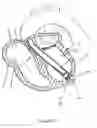 Fig. 16 - Catheter-based tissue remodeling devices and methods