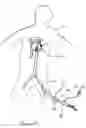 Fig. 22 - Catheter-based tissue remodeling devices and methods