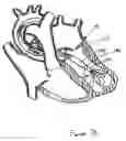 Fig. 28 - Catheter-based tissue remodeling devices and methods