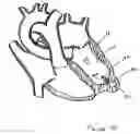 Fig. 30 - Catheter-based tissue remodeling devices and methods