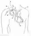 Fig. 01 - Method and apparatus for reliably placing and adjusting a left ventricular pacemaker lead
